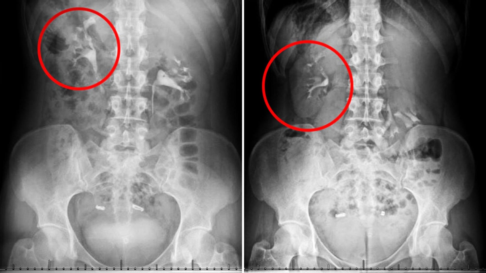 Röntgenfoto van zwevende nieren